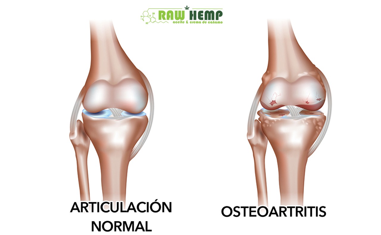 CBD para tratar OSTEOARTRITIS