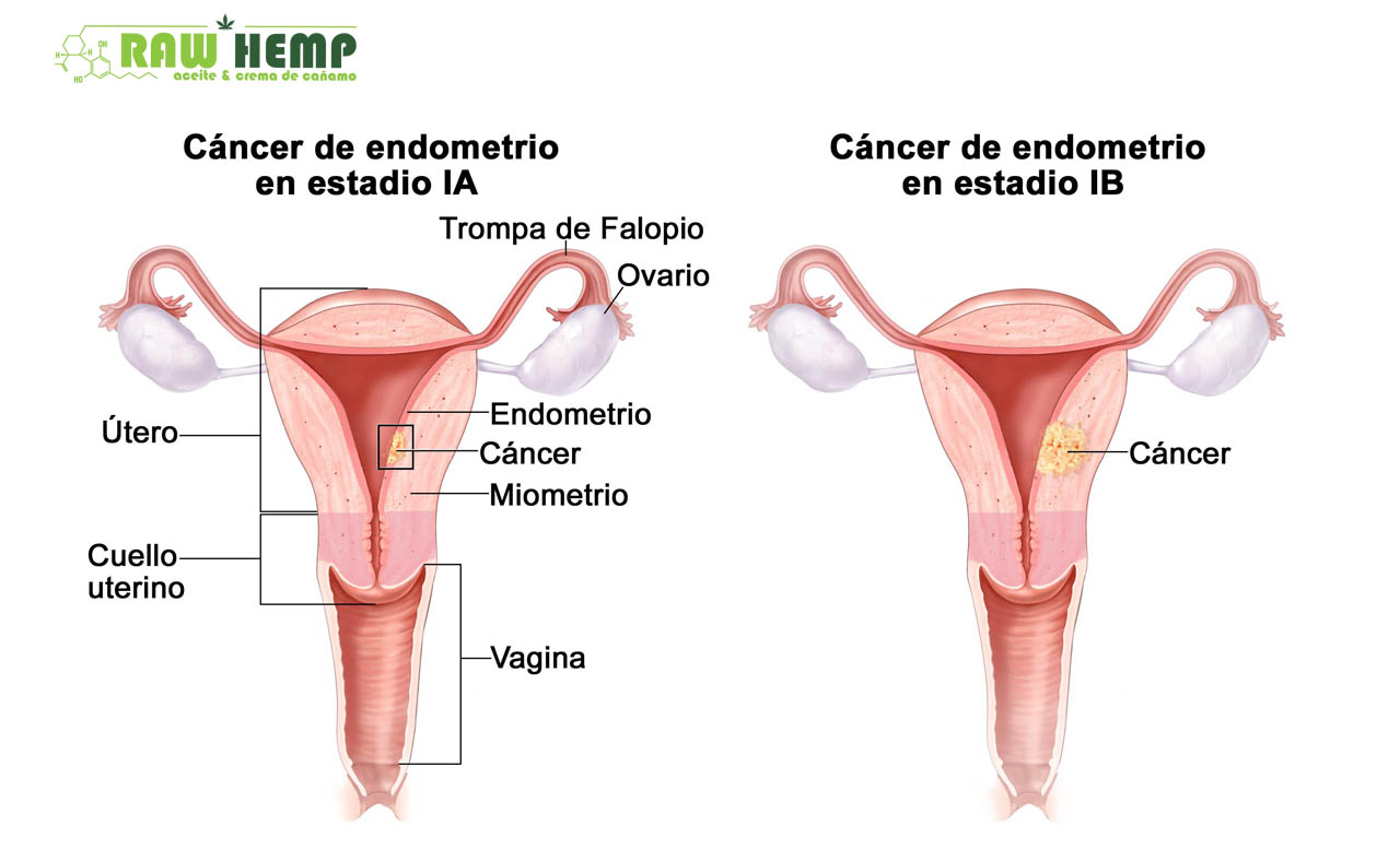 ¿Puede el CBD Inducir Apoptosis en CANCER DE ENDOMETRIO?