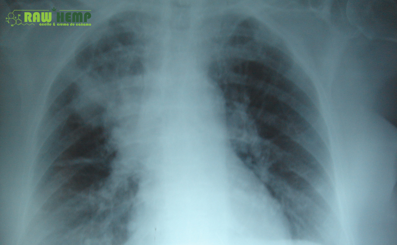 Puede el CBD ayudar a los pacientes con Fibrosis Cística?