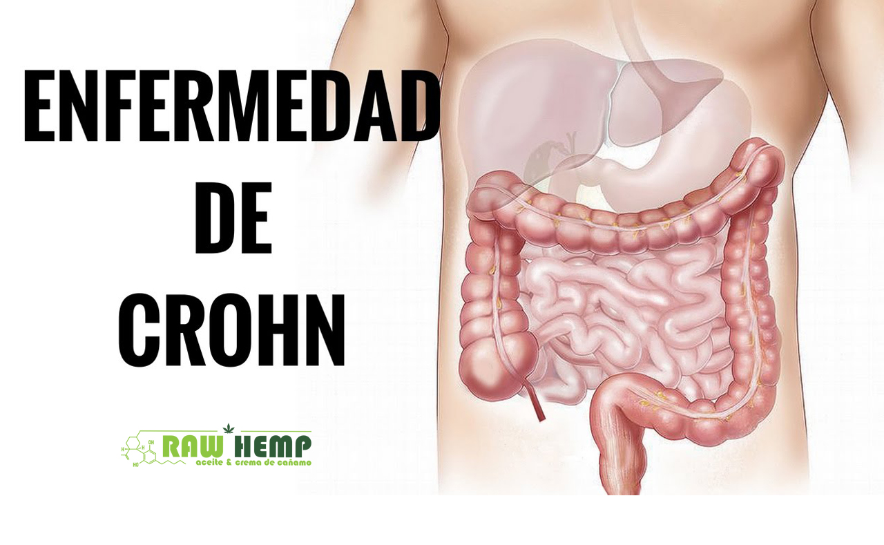 Terapia Cannabinoide Para la Enfermedad de Crohn
