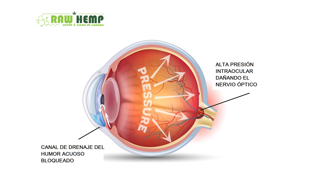 Cannabis Medicinal y Glaucoma: La Alternativa Más Usada para su Tratamiento