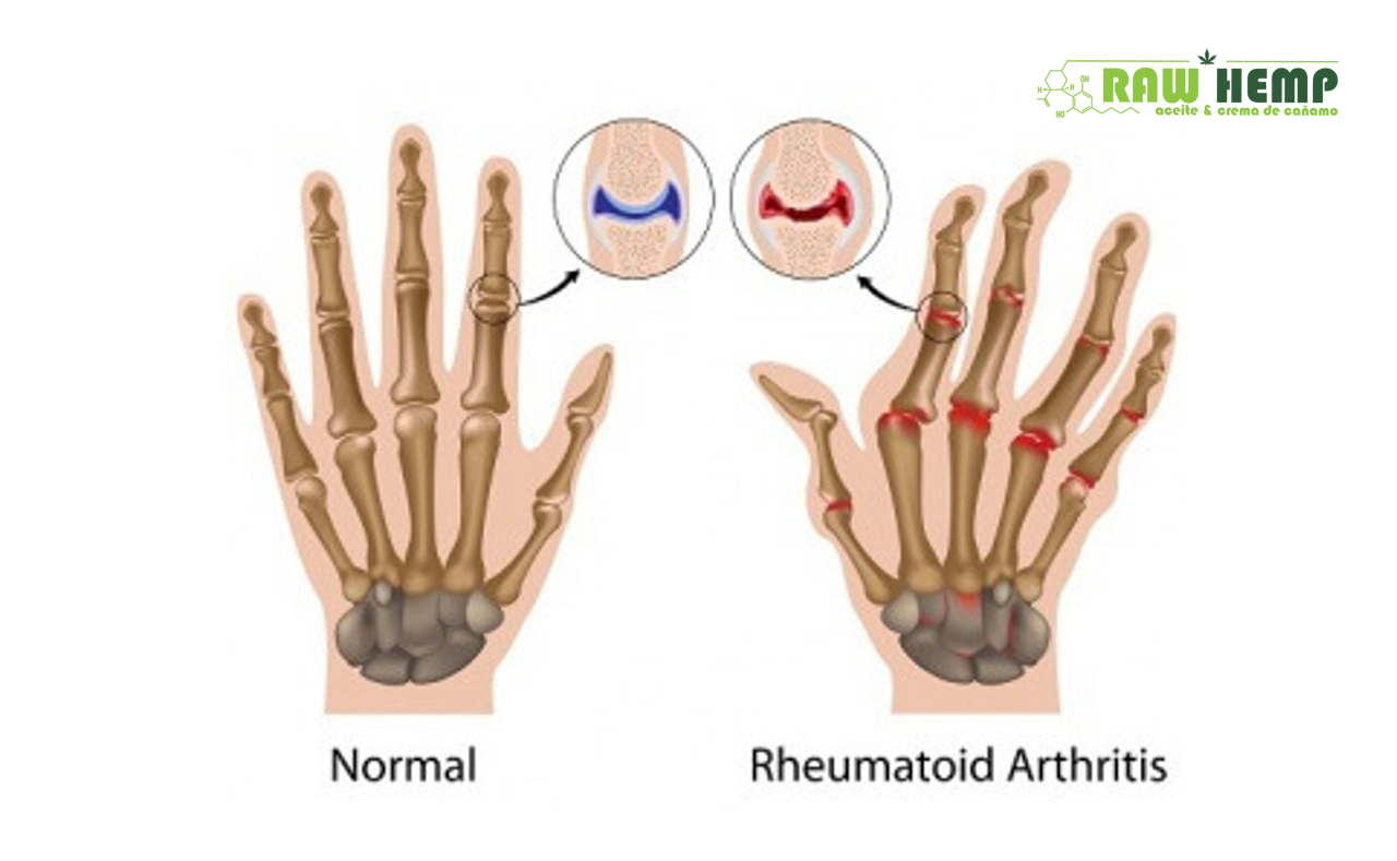 ¿Fin del Dolor en Artritis Reumatoide Gracias a Crema de CBD?