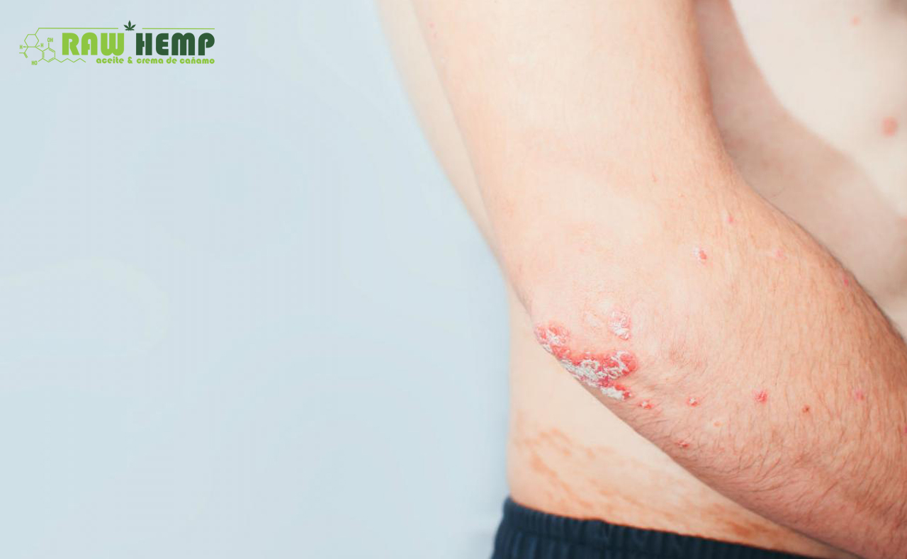 CBD Contra Escamas Producidas Por Psoriasis